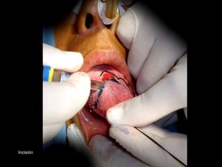 Incisión
 