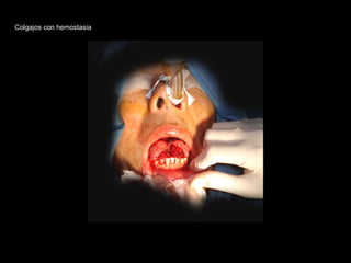 Colgajos con hemostasia
 