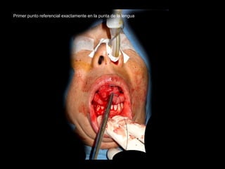 Primer punto referencial exactamente en la punta de la lengua
 