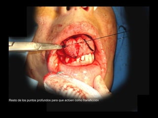 Resto de los puntos profundos para que actúen como transficción
 