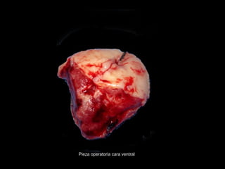 Pieza operatoria cara ventral
 