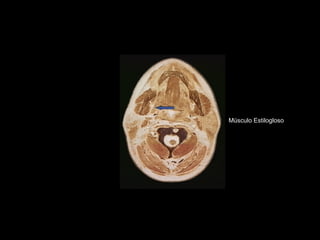 Músculo Estilogloso
 