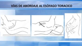 VÍAS DE ABORDAJE AL ESÓFAGO TORACICO
 