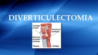 DIVERTICULECTOMIA
 