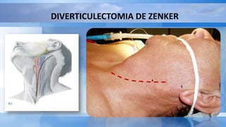 DIVERTICULECTOMIA DE ZENKER
 
