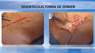 DIVERTICULECTOMIA DE ZENKER
 