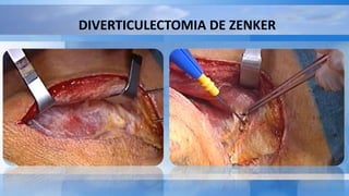 DIVERTICULECTOMIA DE ZENKER
 