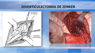 DIVERTICULECTOMIA DE ZENKER
 