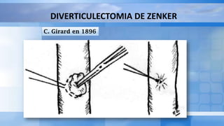 DIVERTICULECTOMIA DE ZENKER
C. Girard en 1896
 