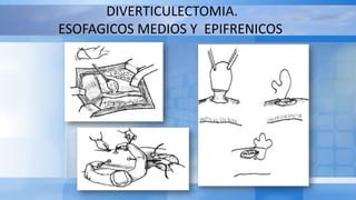DIVERTICULECTOMIA.
ESOFAGICOS MEDIOS Y EPIFRENICOS
 
