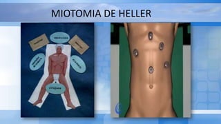 MIOTOMIA DE HELLER
 
