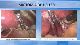 MIOTOMIA DE HELLER
 