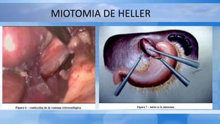 MIOTOMIA DE HELLER
 