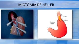 MIOTOMIA DE HELLER
 
