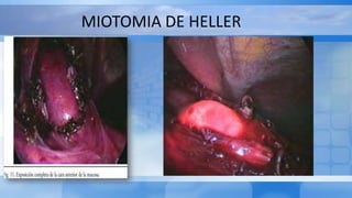 MIOTOMIA DE HELLER
 