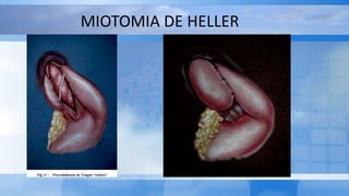 MIOTOMIA DE HELLER
 