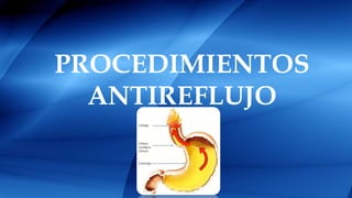 PROCEDIMIENTOS
ANTIREFLUJO
 