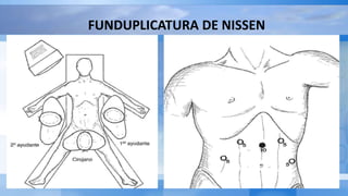FUNDUPLICATURA DE NISSEN
 