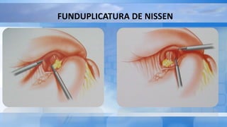 FUNDUPLICATURA DE NISSEN
 