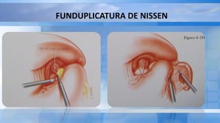 FUNDUPLICATURA DE NISSEN
 