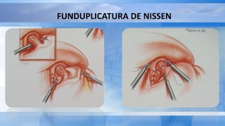 FUNDUPLICATURA DE NISSEN
 