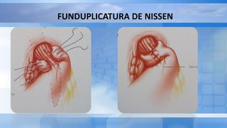 FUNDUPLICATURA DE NISSEN
 