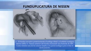 FUNDUPLICATURA DE NISSEN
a - El fundus envuelve posteriormente al esófago distal y al esfínter esofágico
inferior (EEI). b – Sutura anterior del fundus formando una bufanda de 360º.
Como mínimo una de les suturas implica a la pared esofágica para evitar el
deslizamiento.
 
