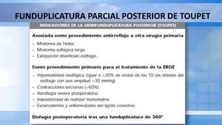 FUNDUPLICATURA PARCIAL POSTERIOR DE TOUPET
 