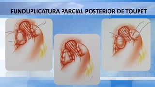 FUNDUPLICATURA PARCIAL POSTERIOR DE TOUPET
 