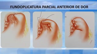 FUNDOPLICATURA PARCIAL ANTERIOR DE DOR
 