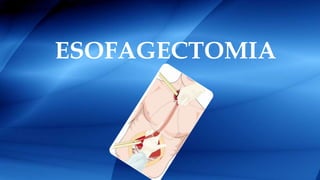ESOFAGECTOMIA
 