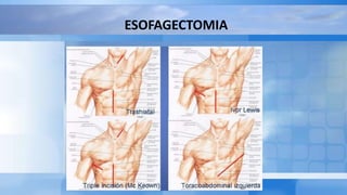 ESOFAGECTOMIA
 