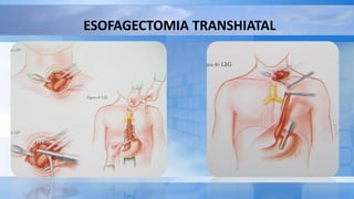 ESOFAGECTOMIA TRANSHIATAL
 