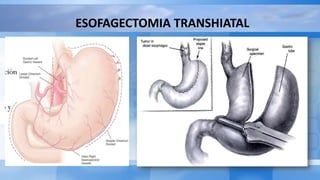 ESOFAGECTOMIA TRANSHIATAL
 
