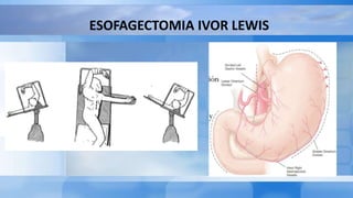 ESOFAGECTOMIA IVOR LEWIS
 