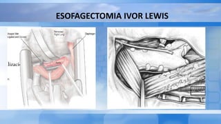 ESOFAGECTOMIA IVOR LEWIS
 