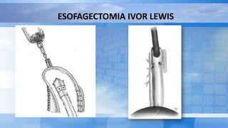 ESOFAGECTOMIA IVOR LEWIS
 