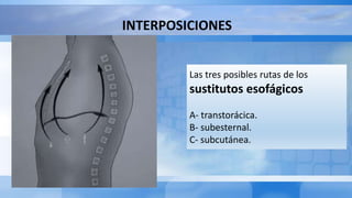 INTERPOSICIONES
Las tres posibles rutas de los
sustitutos esofágicos
A- transtorácica.
B- subesternal.
C- subcutánea.
 