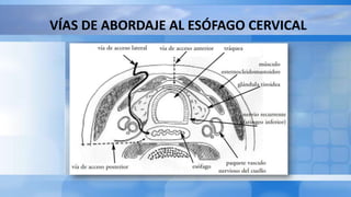 VÍAS DE ABORDAJE AL ESÓFAGO CERVICAL
 