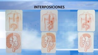 INTERPOSICIONES
 