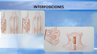 INTERPOSICIONES
 