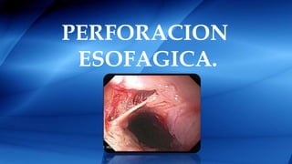 PERFORACION
ESOFAGICA.
 
