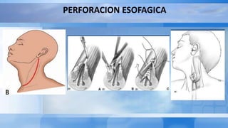 PERFORACION ESOFAGICA
 