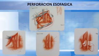 PERFORACION ESOFAGICA
 