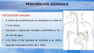 PERFORACION ESOFAGICA
FISTULIZACION DIRIGIDA:
• A través de la perforación se introduce un tubo en
T y se sutura.
• Conectar a aspiración cerrada y hermética a 15 –
20 cms de agua.
• A la 3era o 4ta semana se moviliza y se retira,
dejando colocado el dren de J. Pratt.
 