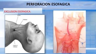 PERFORACION ESOFAGICA
EXCLUSION ESOFAGICA.
 