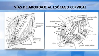 VÍAS DE ABORDAJE AL ESÓFAGO CERVICAL
 