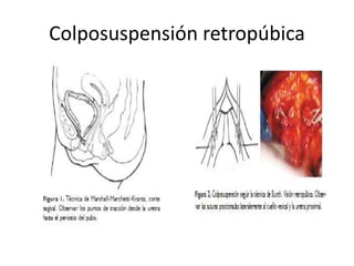 Cirugia de piso pelvico | PPTX
