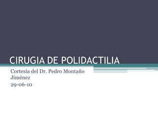 CIRUGIA DE POLIDACTILIA
Cortesía del Dr. Pedro Montaño
Jiménez
29-06-10
 