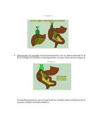 FIGURA 3



Intervenciones de necesidad: Cistoyeyunoanastomosis con asa desfuncionalizada (Y de
Roux u Omega con exclusión), lo más baja posible, en el polo inferior del saco (Figura 4)
FIGURA 4

Cistoduodenoanastomosis, que es la que brinda los resultados menos satisfactorios por la
frecuente colangitis secundaria (Figura 5).

 